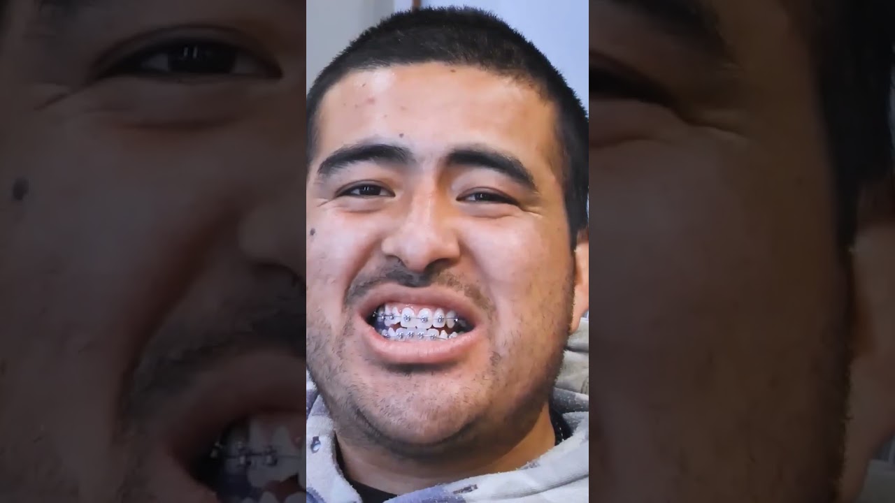 Orthodontics for Class 3 Bite 🦷 | When Lower Teeth Stick Out in Front of Upper Teeth