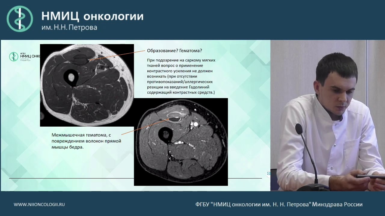 Сложные вопросы лучевой диагностики сарком мягких тканей