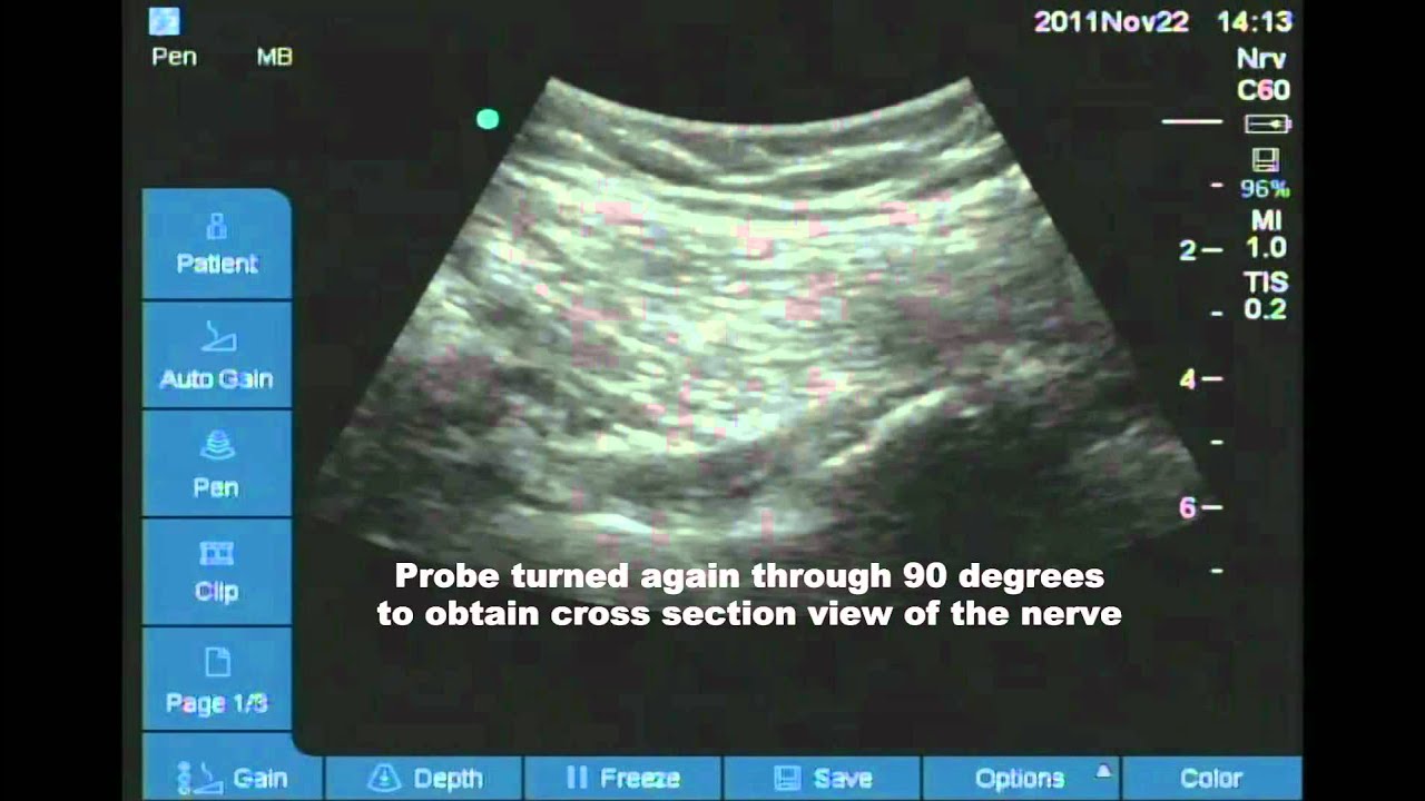 Posterior approach to sciatic nerve