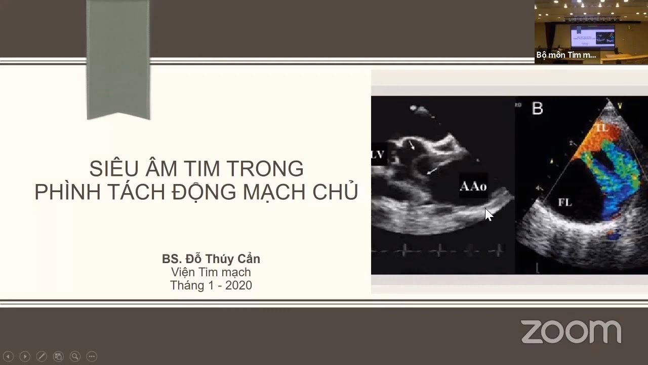 Siêu âm trong Phình tách Động mạch chủ | Siêu âm và CĐHA (buổi 10)