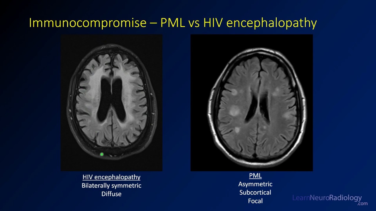Intracranial infections - 4 - Immunocompromise