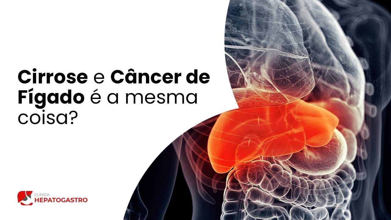 Cirrose e C&acirc;ncer de F&iacute;gado s&atilde;o a mesma coisa? | Cl&iacute;nica Hepatogastro