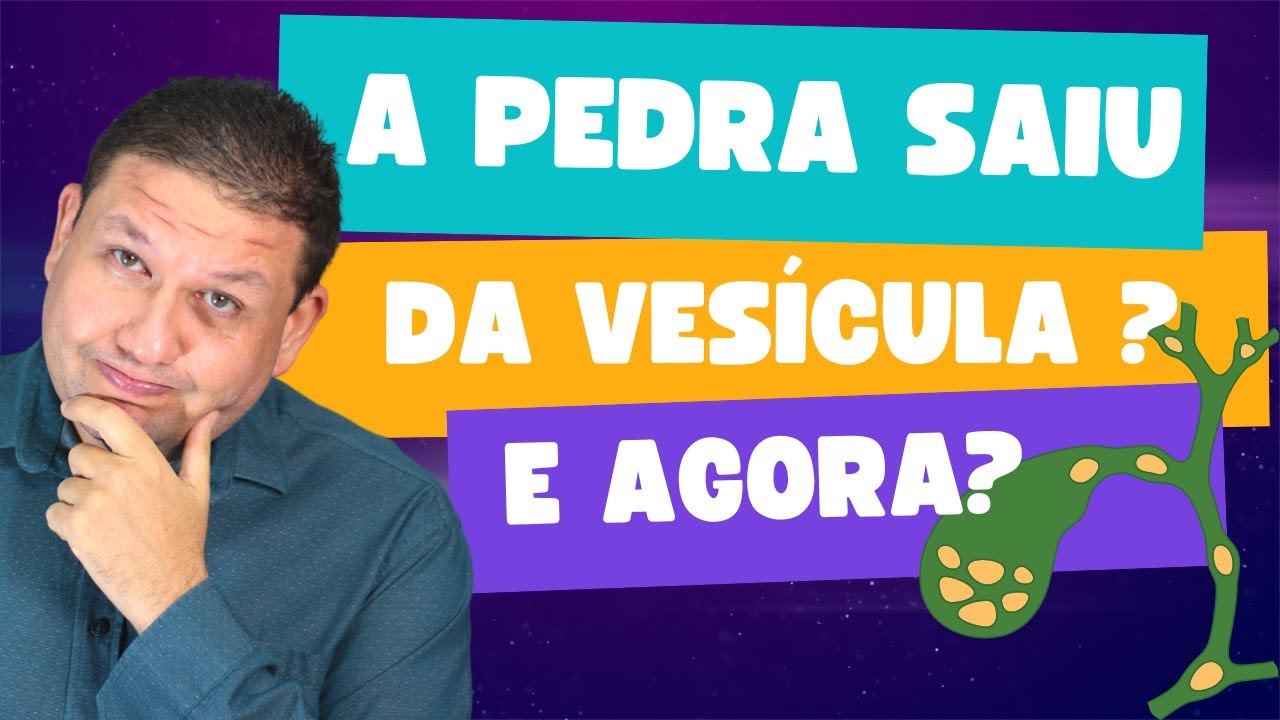 COLEDOCOLITÍASE !! Complicação de pedra na vesícula. O que fazer quando a pedra sai da vesícula.