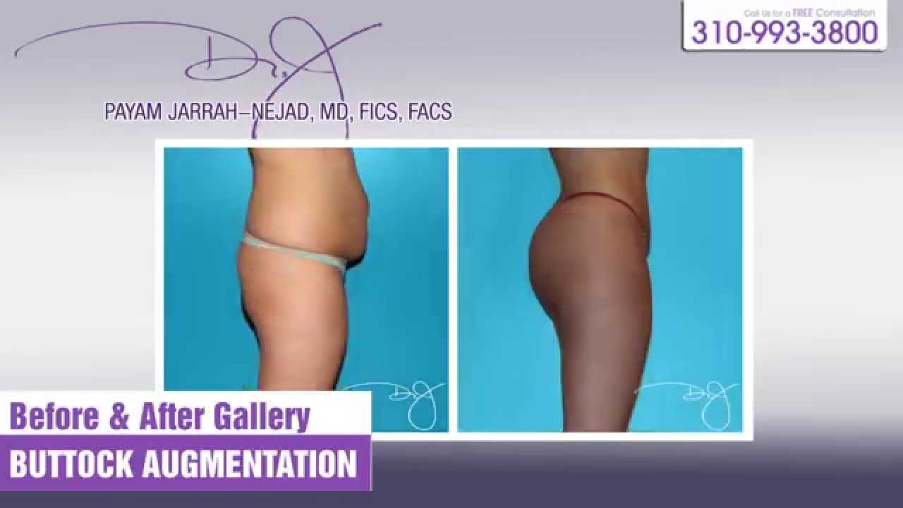 Buttock Augmention Before & Afters | Dr. J Plastic Surgery | Payam Jarrah-Nejad