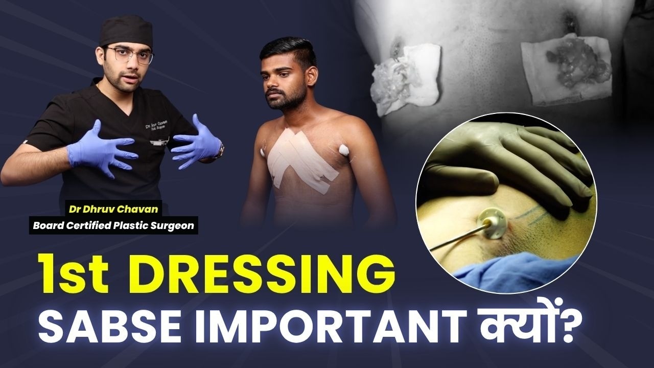 🛑 Gynecomastia Surgery का पहली Dressing! | Important Dressing & Garment | Dr DC Plastic Surgeon Pune