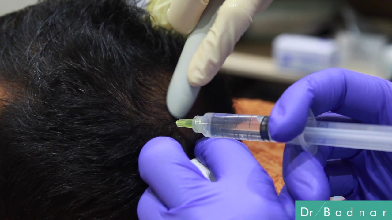 PRP Cheveux - Traitement au Plasma Riche en Plaquettes (PRP) - Dr Martial Bodnar Toulouse