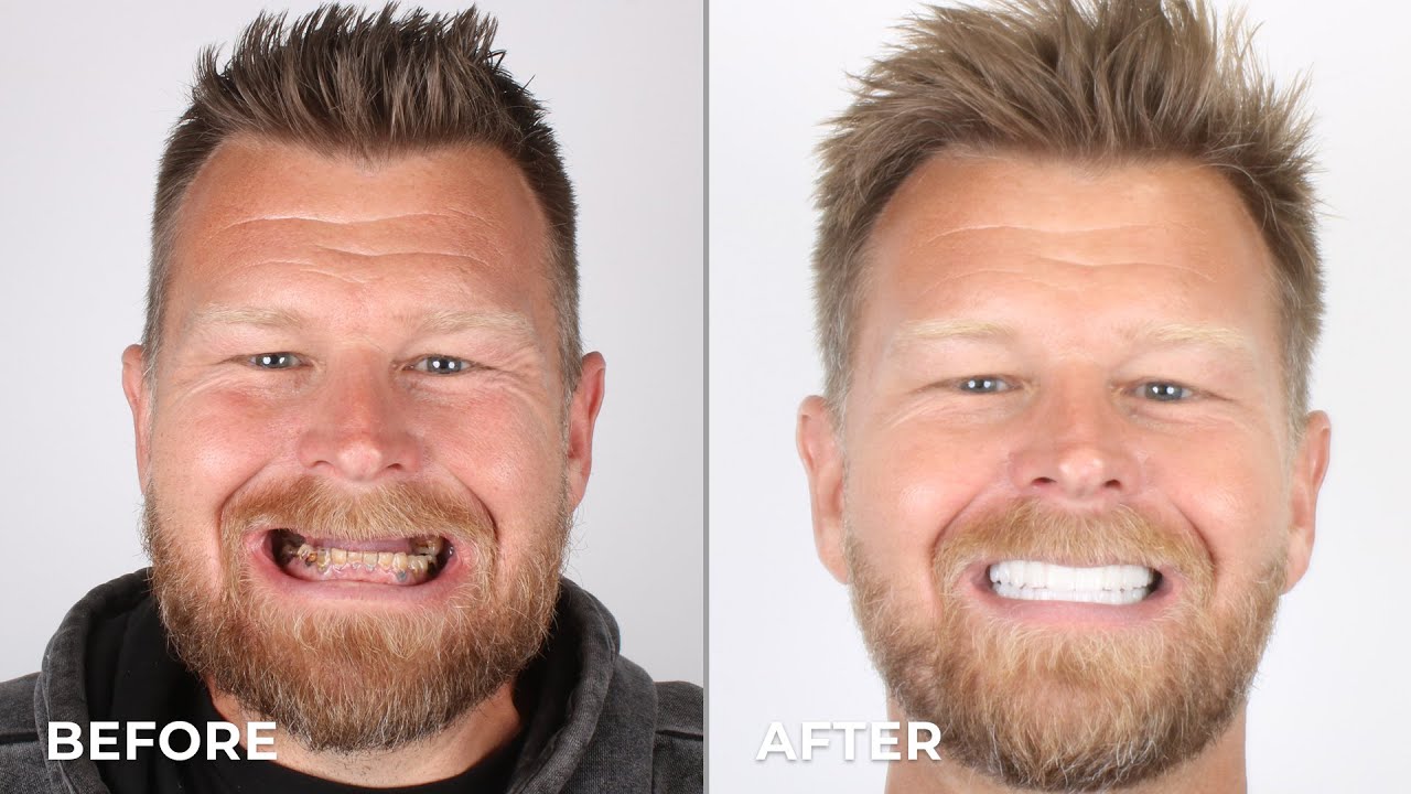 Check Out Brandon's Transformation After Getting Dental Implants!