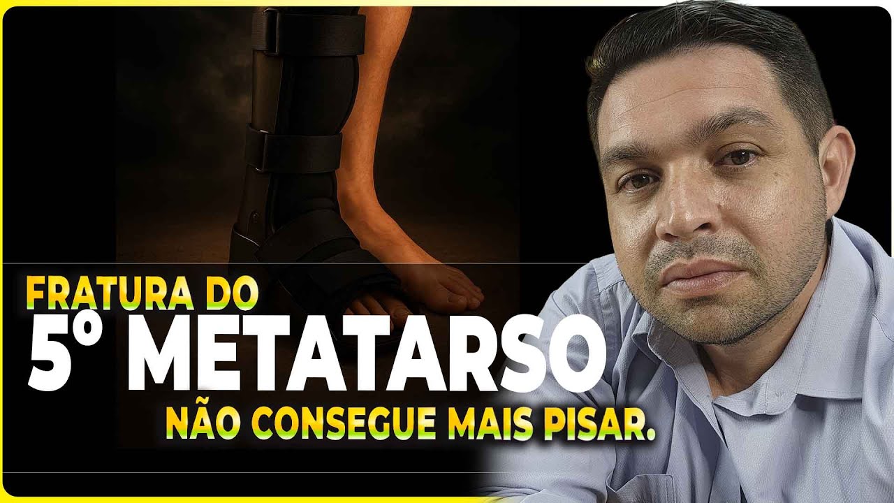 FRATURA do 5 Metatarso TEMPO DE RECUPERAÇÃO e QUANDO PISAR