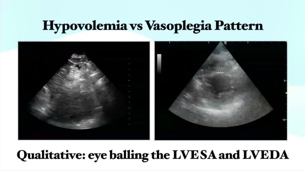 Fluid Assessment with POCUS (Hidayah Shafie, WISAC 2023)
