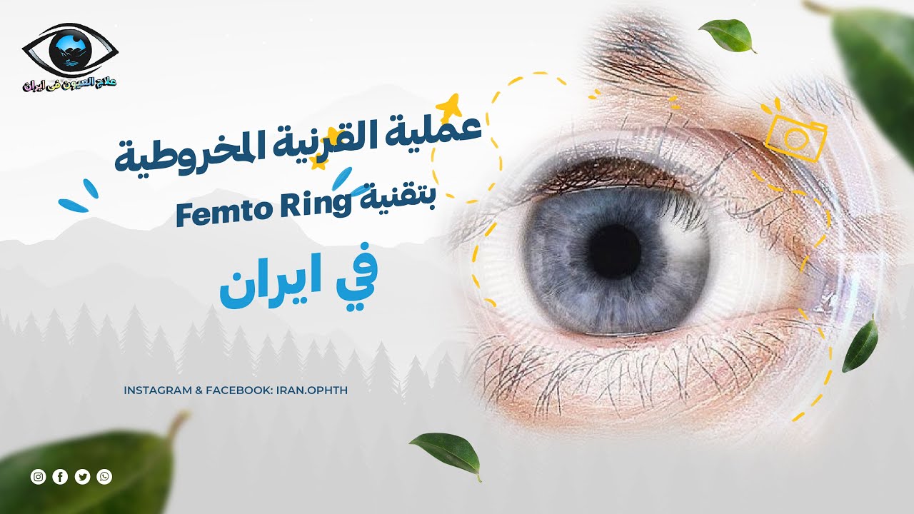 عملية القرنية المخروطية بتقنية Femto Ring