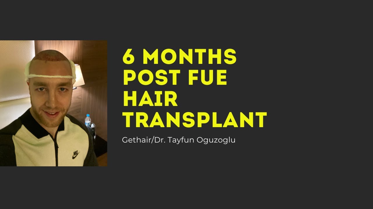 6 MONTH FUE HAIR TRANSPLANT UPDATE, GETHAIR/DR TAYFUN