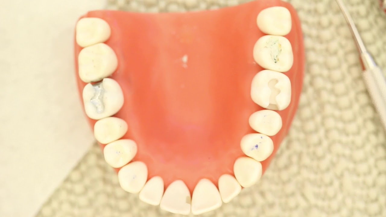 Marginal Ridge Proximal Box Tear Out