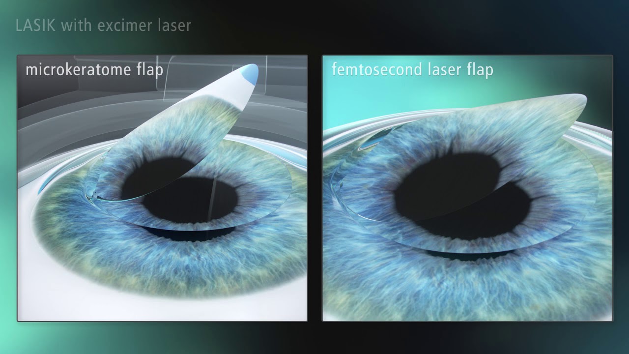 LASIK(Laser in-situ keratomileusis
