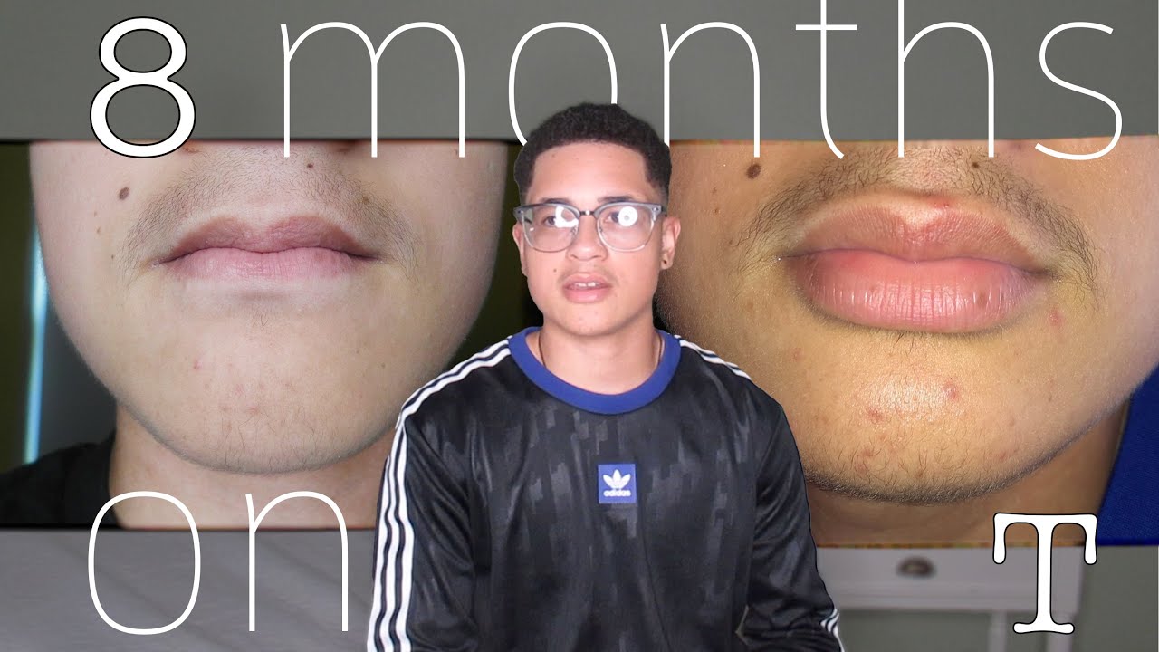 8 MONTHS ON TESTOSTERONE FTM