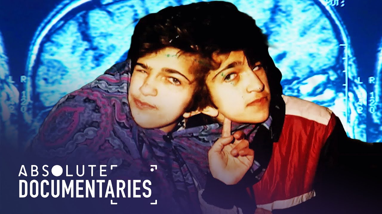 The Incredible Separation: The Conjoined Twins' Pioneering Surgical Journey | Absolute Docum
