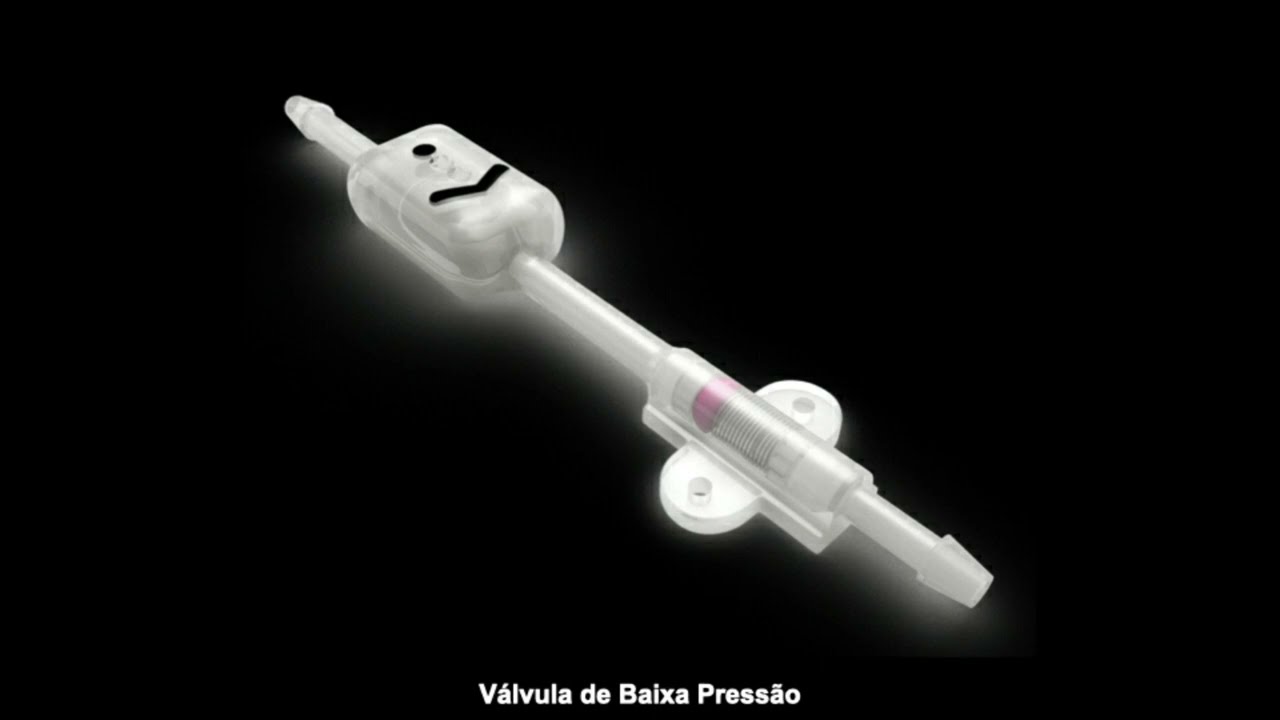 Revisão de válvula para Hidrocefalia em criança devido a hiperdrenagem.