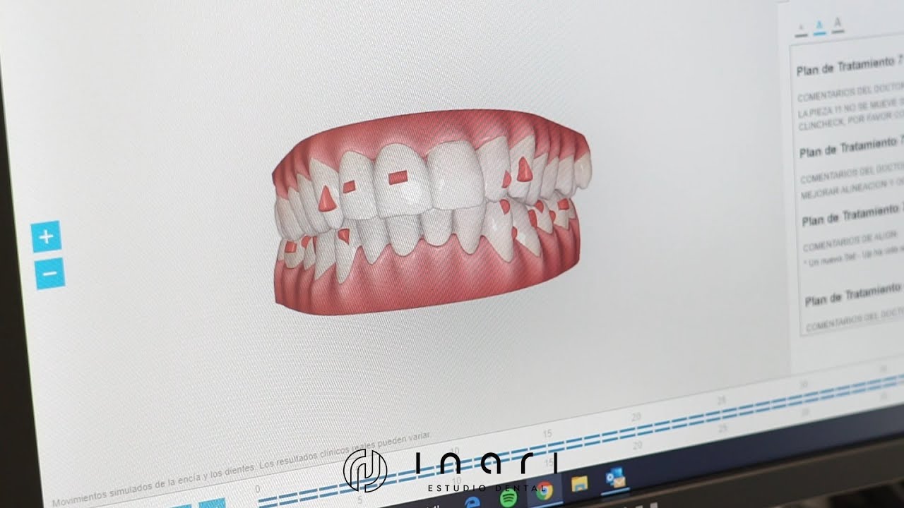 Clincheck Invisalign