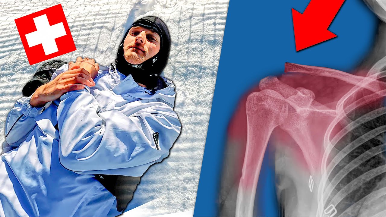 ZO HEB IK MIJN SCHOUDER KAPOT GEMAAKT! | 