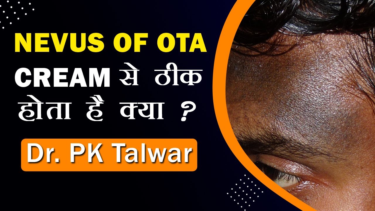 Nevus of OTA Cream से ठीक होता है क्या? Can Nevus of OTA Be Removed by Cream | Dr. PK Talwar