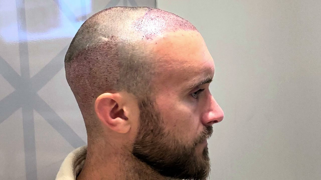 3 mois après ma greffe de cheveux réalisée en Turquie avec la clinique COSMEDICA
