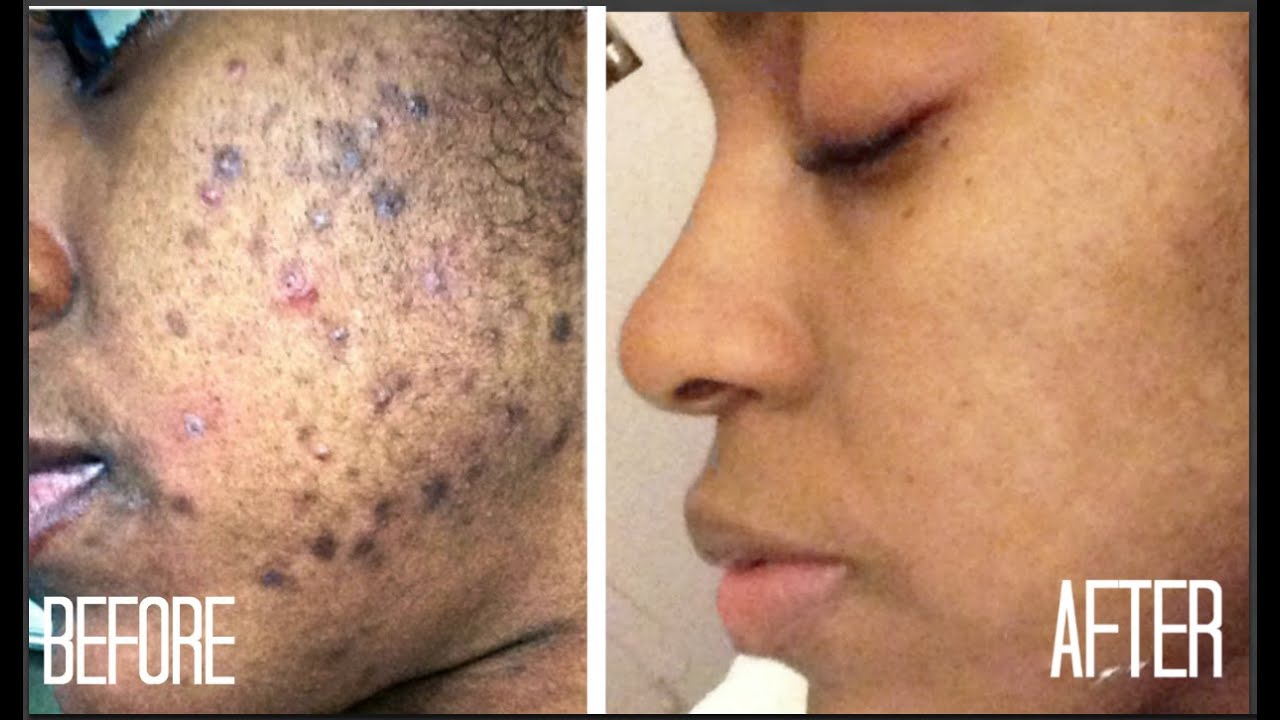 SKIN| How I Got Rid of Dark Scars (Hyperpigmentation) & Acne + GIVEAWAY!