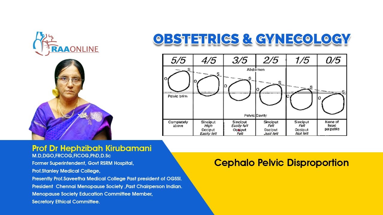 Cephalo Pelvic Disproportion - MD/DNB Obstetrics & Gynaecology