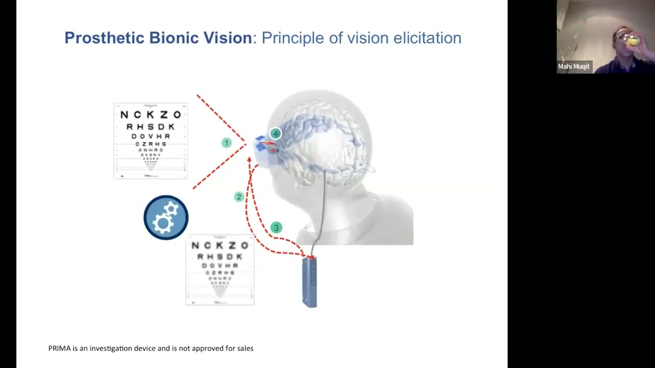 Revolutionary bionic chip for dry AMD