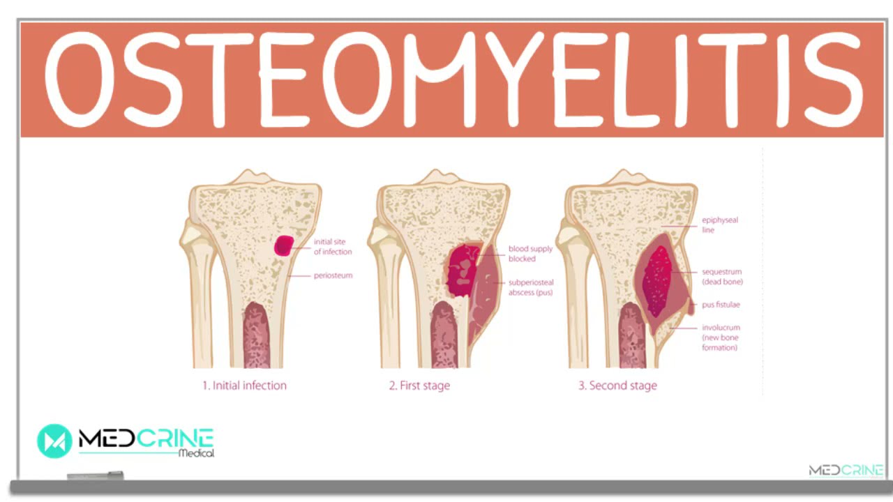 Osteomyelitis:  Classification, Causes, Pathophysiology, Signs and Symptoms, Diagnosis and Treatment