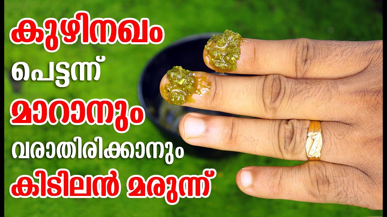 കുഴിനഖം ആയുസ്സിൽ വരാതിരിയ്ക്കാനും വന്നവർക്കും ഇത് ചെയ്തോളു|Home made Natural Toenail Fungus Remedies