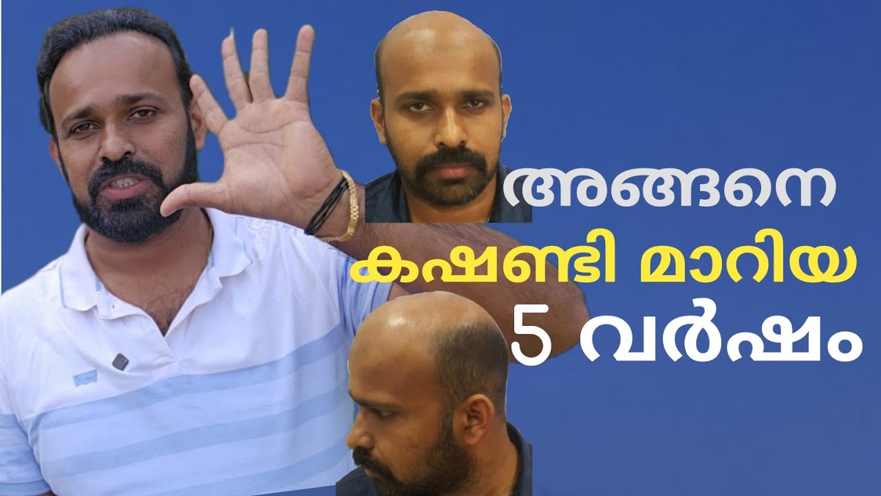 5 Year After Hair Transplantation 😍