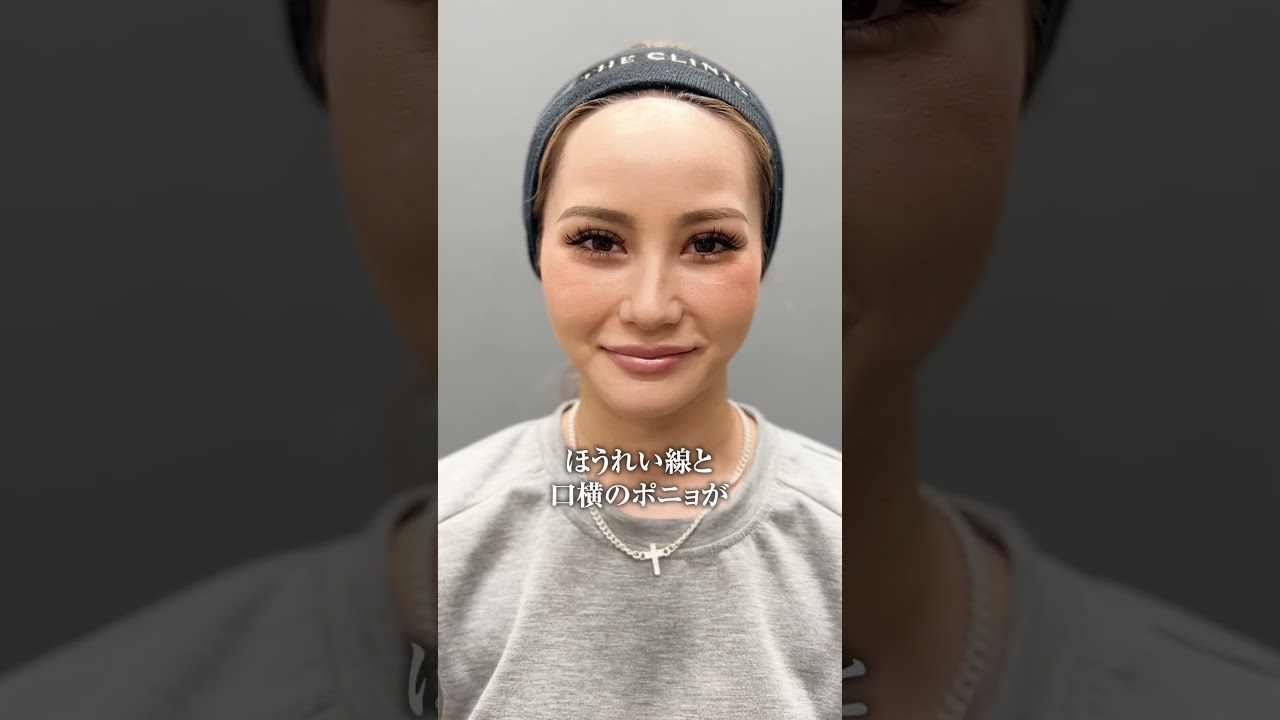 モフィウスでほうれい線と口横のポニョが消える？美容施術の驚きの効果！
