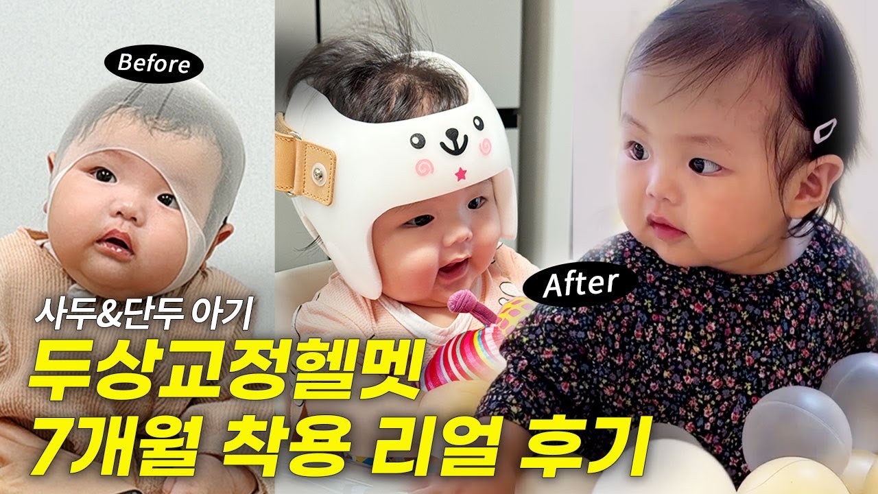 두상교정헬멧 7개월 착용 후 변화 (5개월~돌까지 내돈내산 후기)