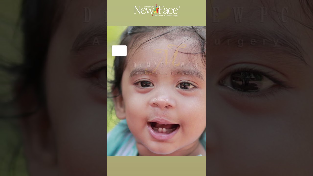 Cleft Lip & Palate Amazing Transformations | A Brighter Future Begins with a Smile | Dr Mathew PC