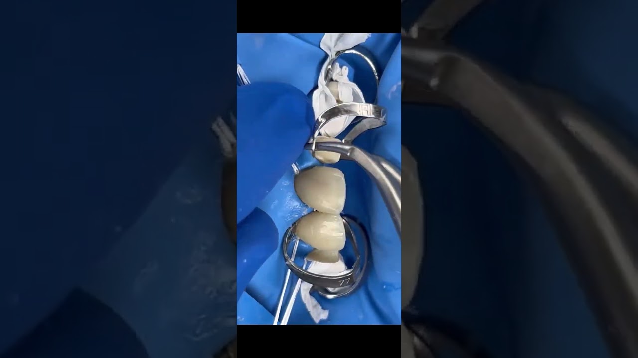 Teeth gaps closure /Veneer bonding technique/ Porcelain veneers in Chennai / Diastema closure
