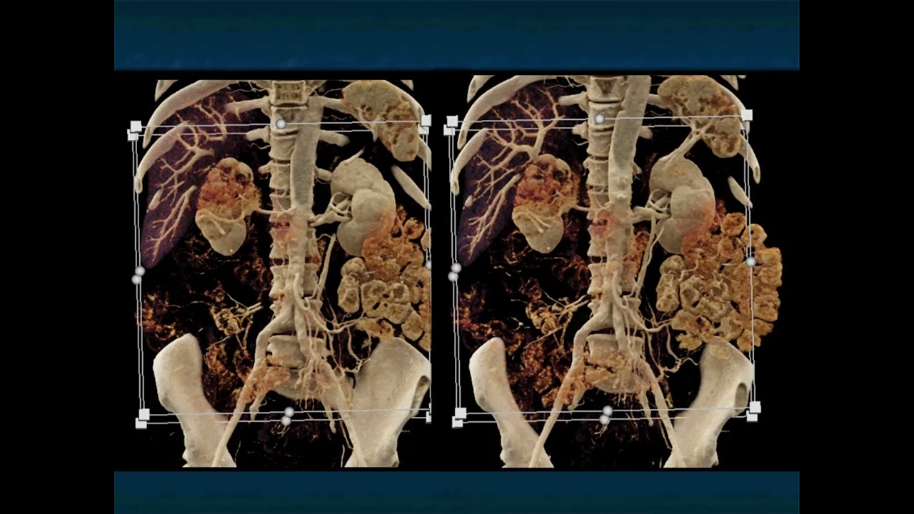 Transitional Cell Carcinoma of the Kidneys 2022: Pearls and Pitfalls - Part 2