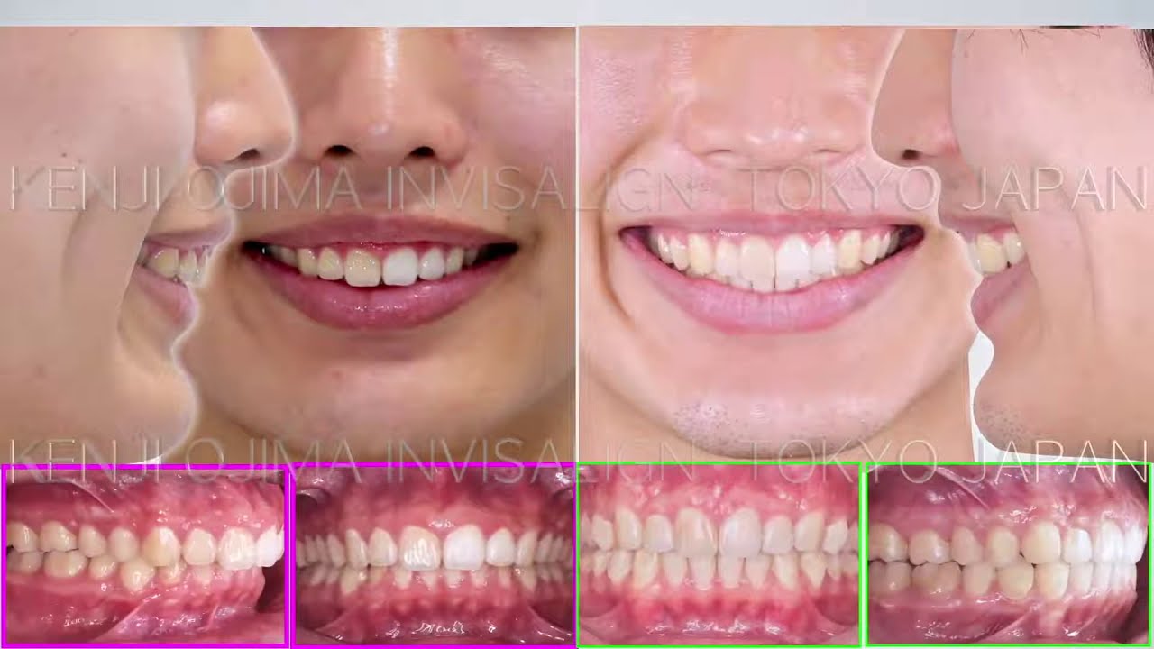DSD x Invisalign Gummy Smile Anterior Intrusion with TADs【DSDとインビザライン ガミースマイルの矯正治療]