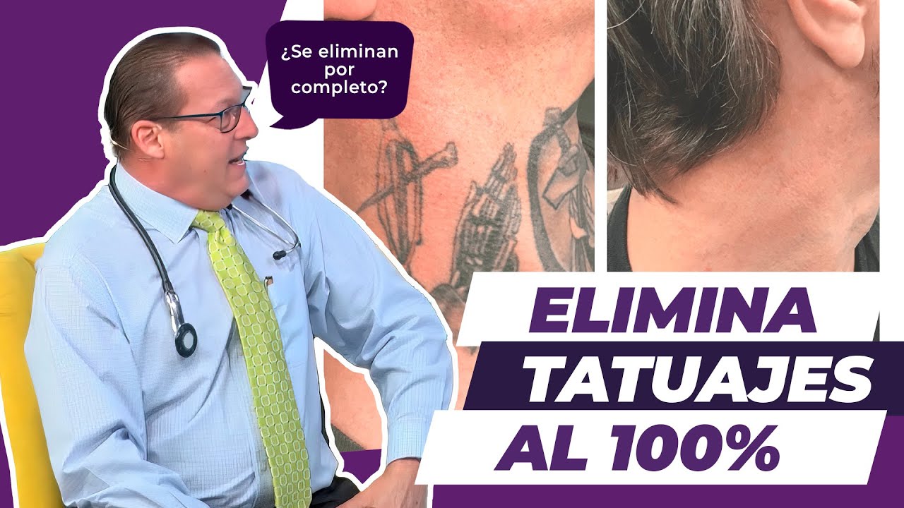 Cómo eliminar un tatuaje por completo