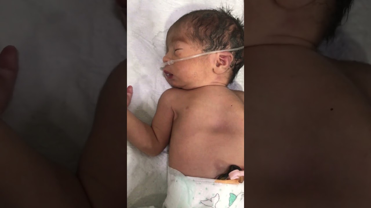 Neonatal Baby with Respiratory Distress Syndrome (RDS) | Critical NICU Case