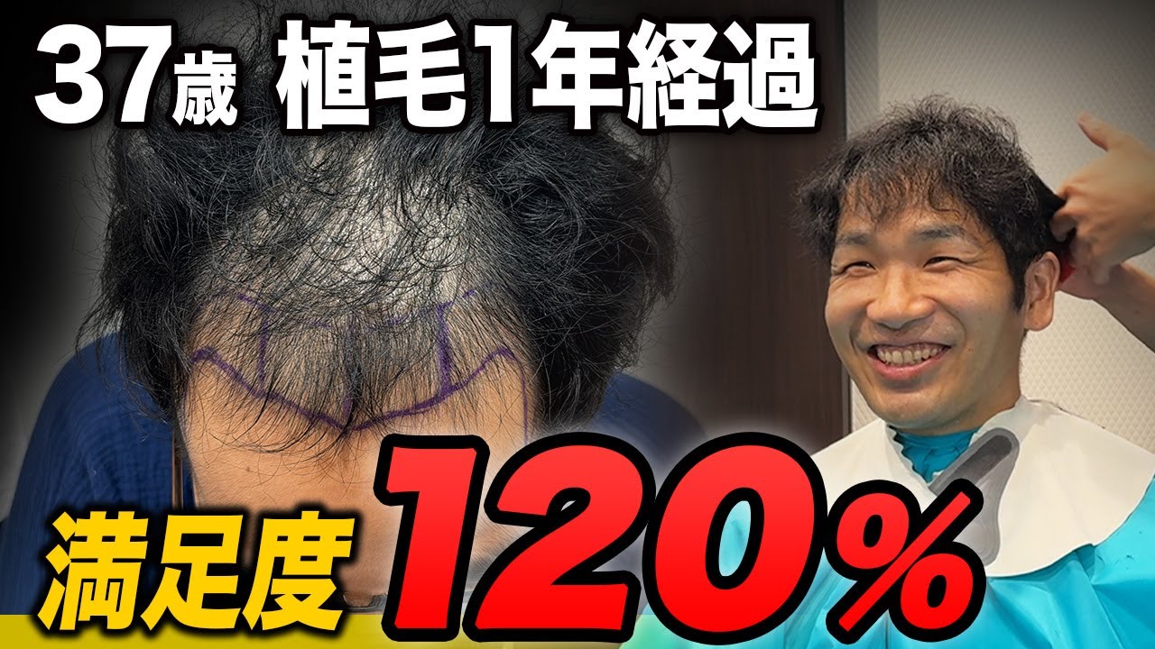 【満足度120%】植毛前は薄毛すぎた37歳の変化がスゴすぎる...！