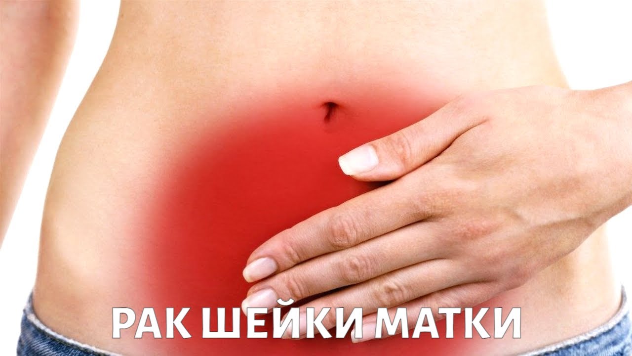 Рак шейки матки: что это такое и как его распознать? Вопросы гинекологу