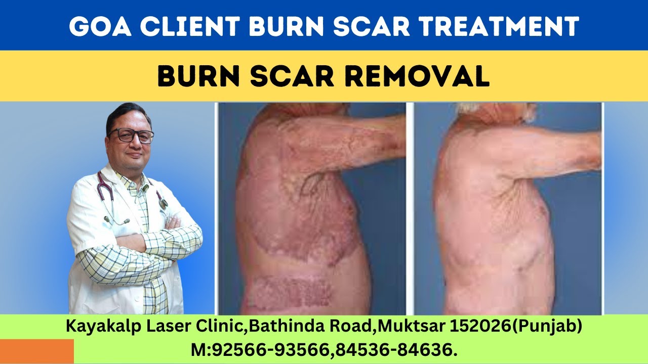 Goa Client Burn Scar Treatment |  Burn Scar Removal | Kayakalp Laser Clinic