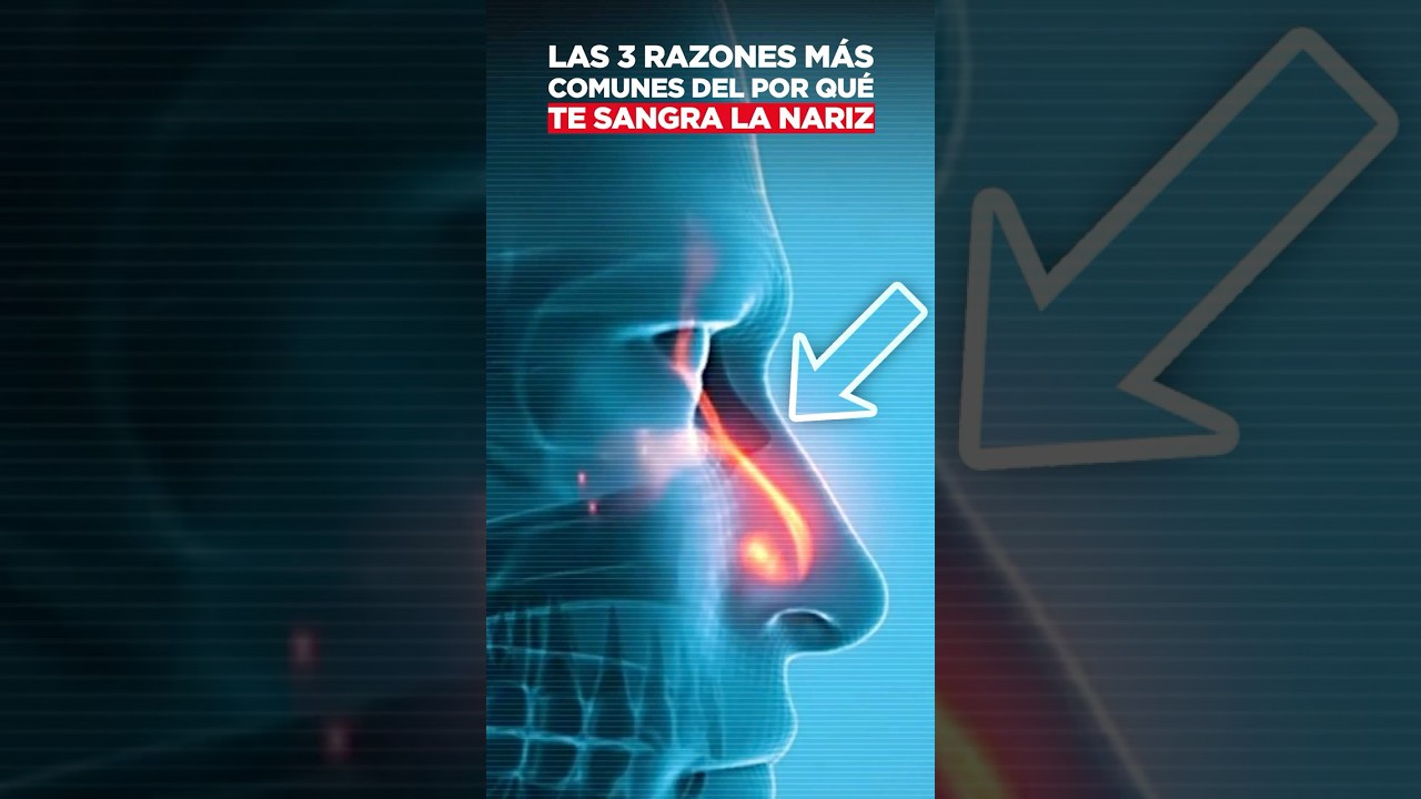 Las 3 razones m&aacute;s comunes del por qu&eacute; te sangra la nariz