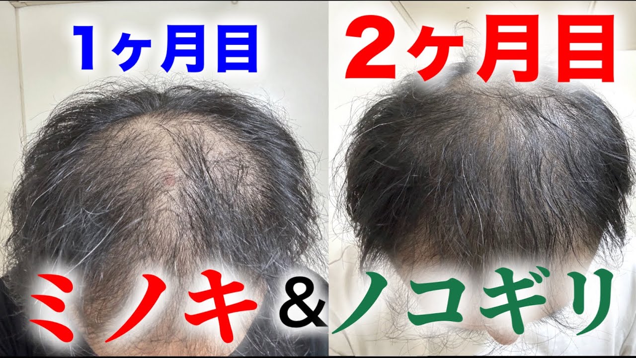 セルフ薄毛治療２ヶ月目の経過報告、と、落武者時代の過去動画