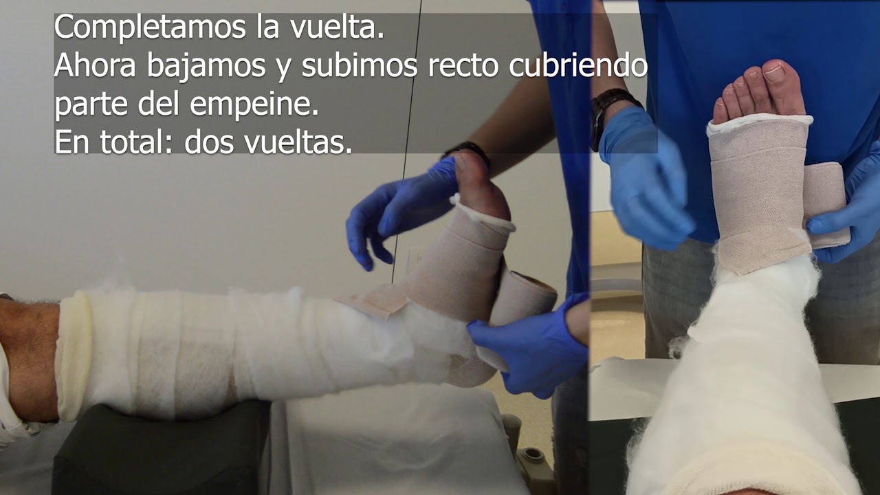 Vendaje multicapa multicomponente con vendas de corta tracción en circular (20mmHg)