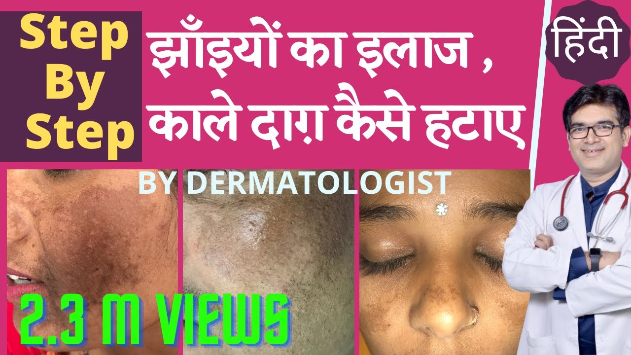 झाँइयों का इलाज | झाँइयों की बेस्ट क्रीम | चेहरे के काले दाग़ हटाने के तरीक़े | Dermatologist| Hindi