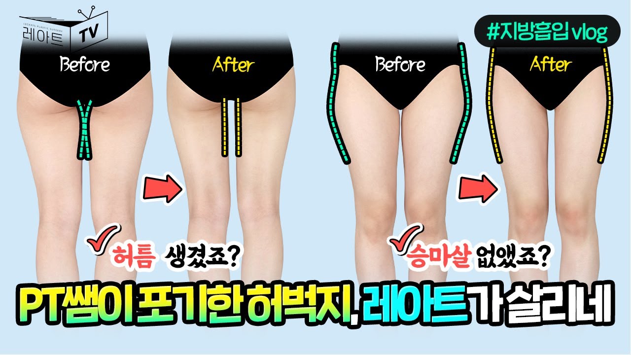 [허벅지 살빼기] 지방흡입으로 허벅지틈 만들기👌 승마살 빼기👌 [레아트성형외과]