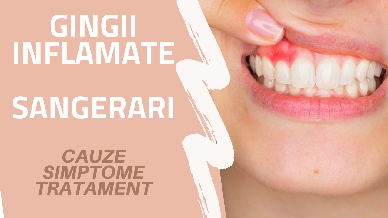 DE CE NE SANGEREAZA GINGIILE? | Gingivita | DR. ANA MARIA OPREA | Ce Sa Fac