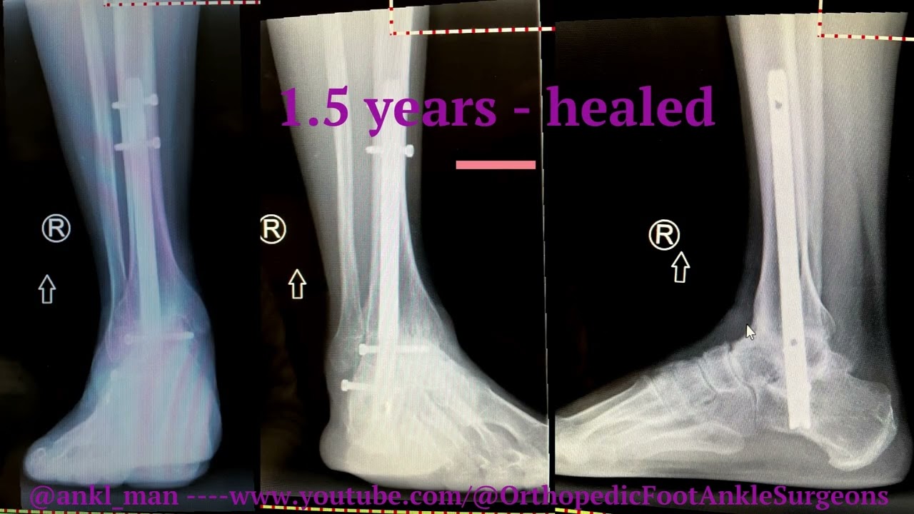 Talus Body fracture leading to Ankle and Subtalar arthritis - Tibiotalocalcaneal (TTC) Fusion Nail