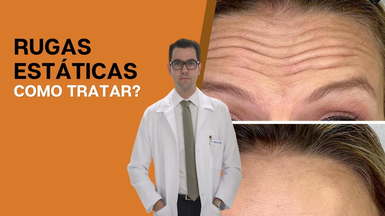 Rugas estáticas: Como tratar?