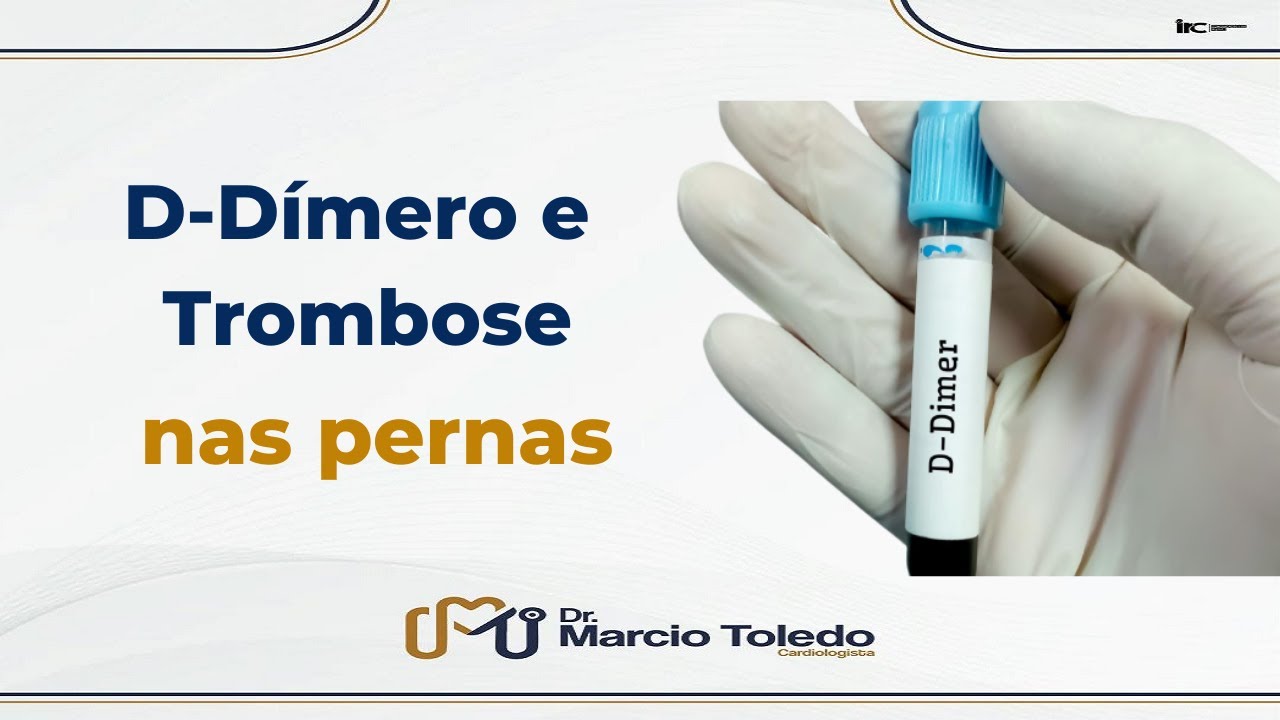 D-D&iacute;mero e Trombose nas Pernas | Dr Marcio Toledo